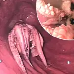 Artsen verbijsterd: levende octopus uit keel van patiënt in Singapore gehaald