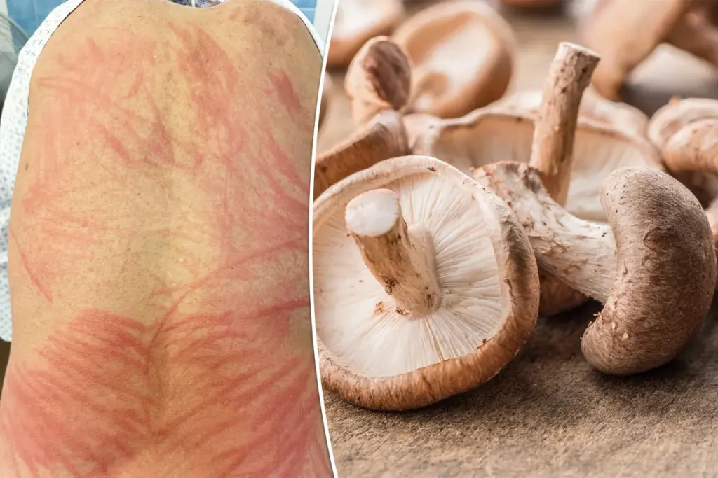 Man krijgt zeldzame ‘shiitake-uitslag’ door onvoldoende verhitte paddestoelen