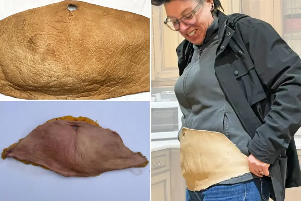 Vrouw transformeert 2 kilo overtollige huid tot menselijk leer