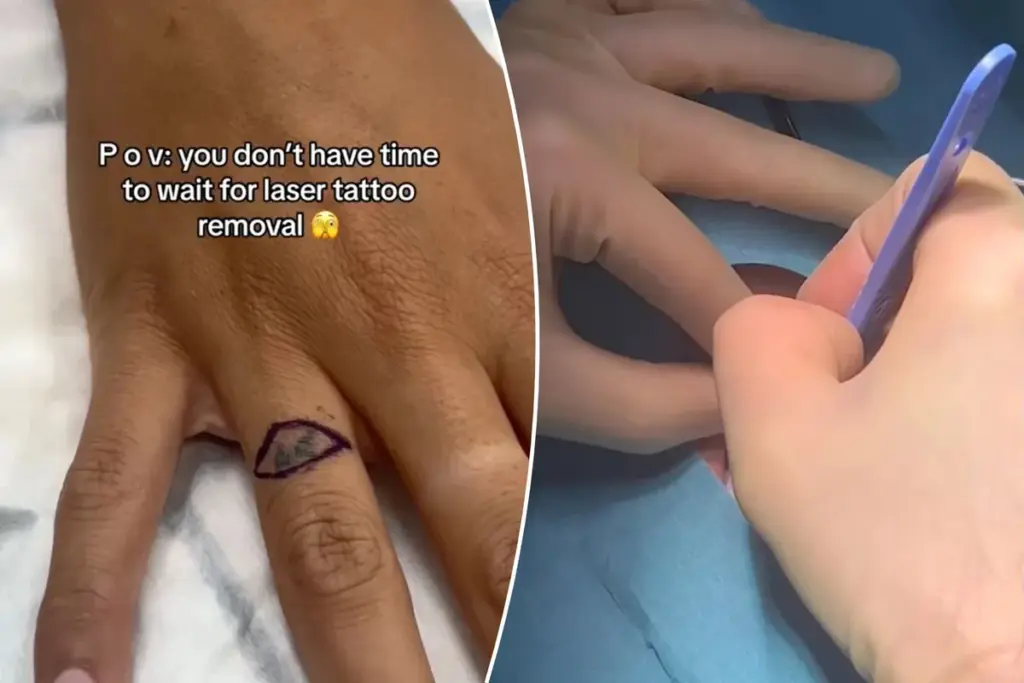 Geen zin in een lelijke ring-tatoeage? Deze Nederlandse vrouw liet ’m simpelweg uitsnijden