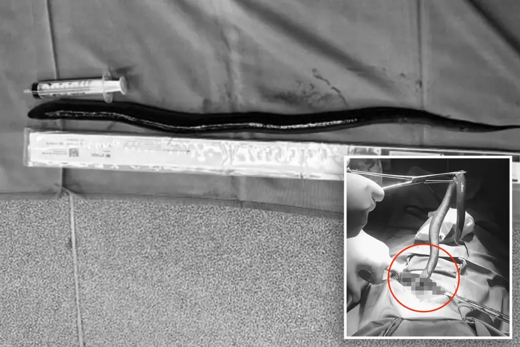 Levende paling van 30 centimeter uit buik Vietnamese man gehaald: bizar maar waar