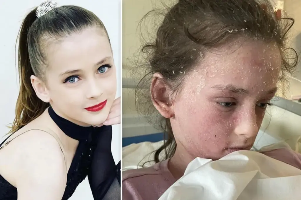 11-jarige danseres uit Rotterdam allergisch voor eigen tranen en zweet door eczeem