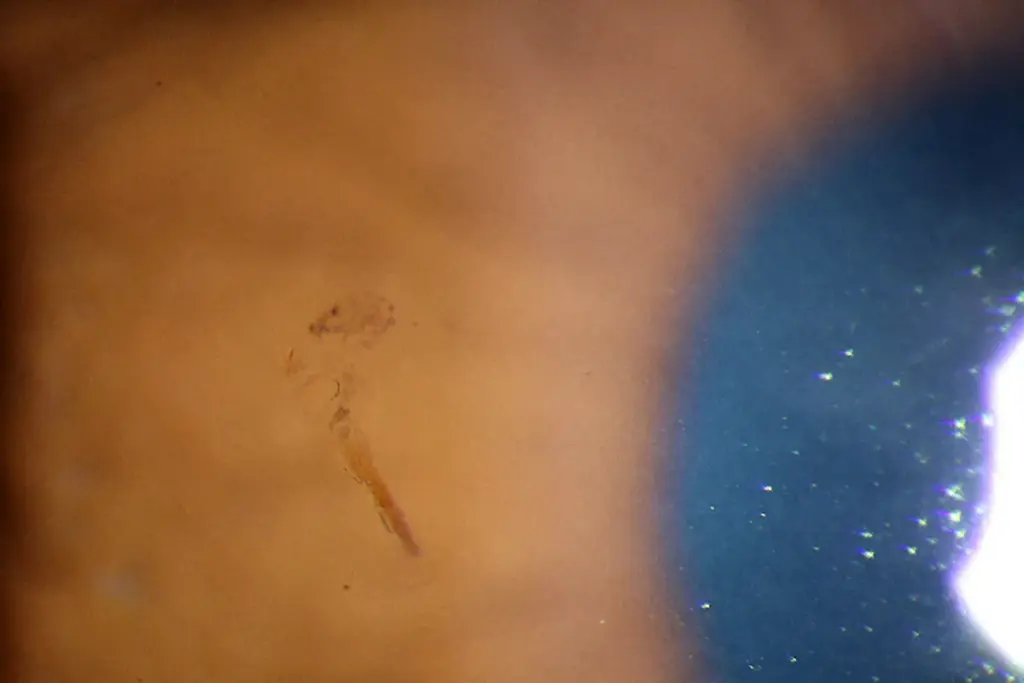 15 jaar oude splinter in oog van man uit Boston ontdekt: het bizarre medisch verhaal