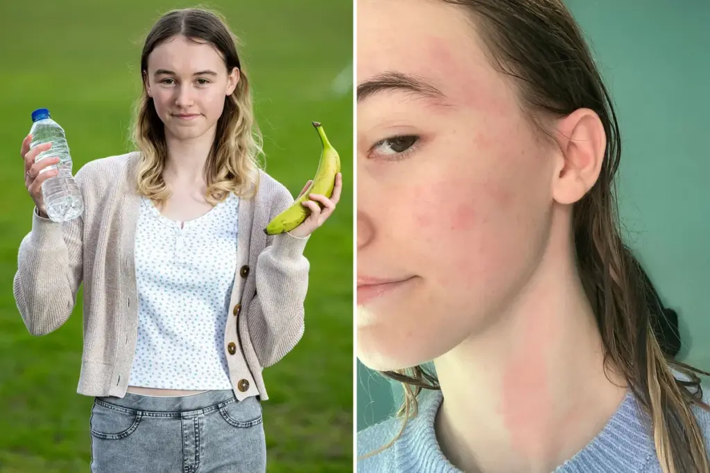Waterallergie: regen maakt mijn huid ondraaglijk – het verhaal van Chloe